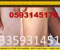 Stretch marks solutions